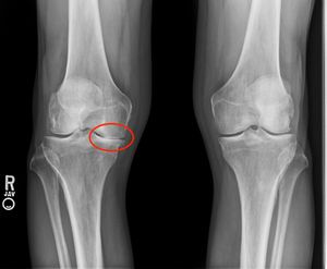 x-ray of knees, showing arthritis in the right knee